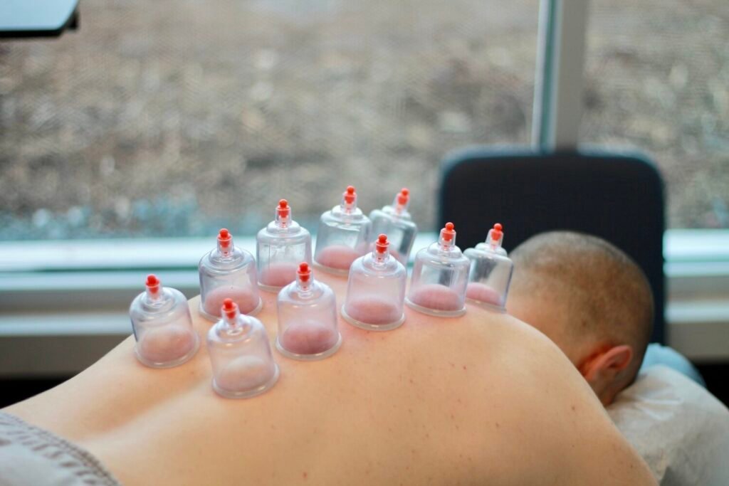 Cupping Therapy (Static & Fire)